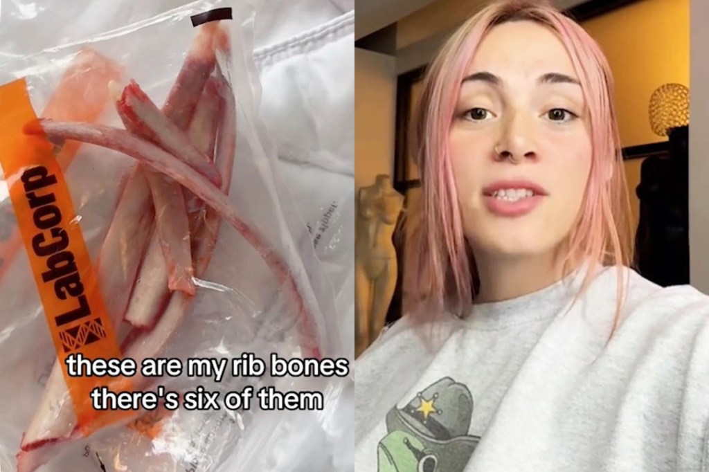 Influencer Who Spent $17K to Remove 6 Ribs Plans to Turn Bones Into Crown